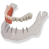 MINI INTER Interims Implantate