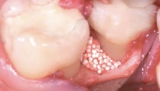 Easy Graft Crystal 150-3