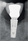 Preview: The K Kit Implantoplasty