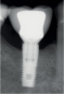 Preview: The K Kit Implantoplasty