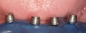 Preview: Matrize mit O-Ring