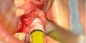 Preview: NanoBone® QD 1 x 2,5 ml