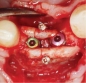 Preview: Micro Screw System