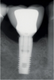 The K Kit Implantoplasty