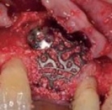 Preview: Root Sectioning Kit Samarani 1