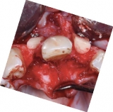 Preview: Screw-System TX Professional