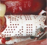 Preview: Cytoplast™ Titanverstärktes PTFE-Mesh 20x25mm