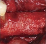 Preview: Cytoplast™ Titanverstärktes PTFE-Mesh 38x38mm