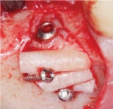 Micro Screw System
