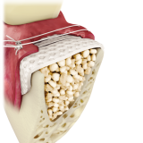 Cytoplast TXT-200 Hochdichte PTFE-Membran 12x24mm