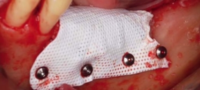 Membran Fixier-Schraube 1,6 x 4mm (10 Stück) - Kopie