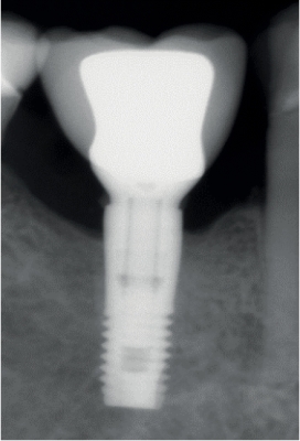 The K Kit Implantoplasty