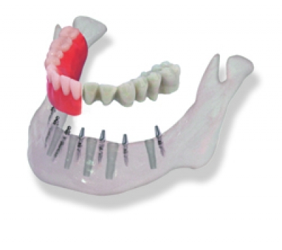 MINI INTER Implantat Länge 13mm (2 Stück)