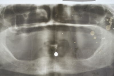 Röntgen-Messkugeln 5mm (10 Stück)