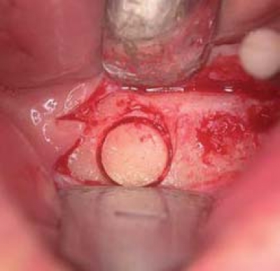 Transfer-Ring-Control I