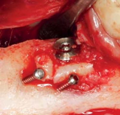 Trephine Ejection Kit