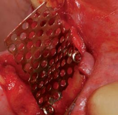 Screw-System TX