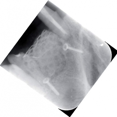 Screw-System TX