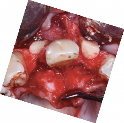 Screw-System TX Professional