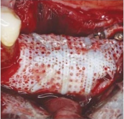 Cytoplast™ Titanverstärktes PTFE-Mesh 40x50mm