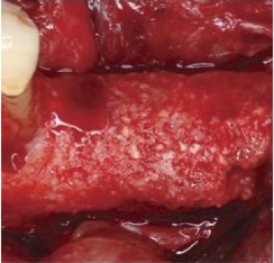 Cytoplast™ Titanverstärktes PTFE-Mesh 20x25mm