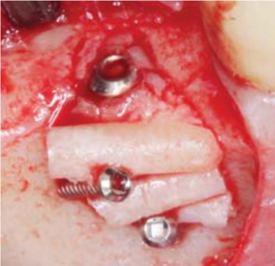 Micro Screw System