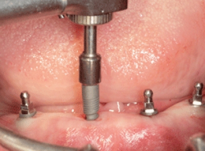 Implantat-Einschrauber (WST)