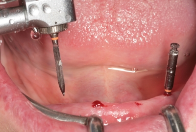 Cortical Drill