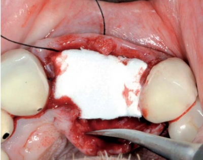 collafleece® botiss, 2 x 2cm (12 Stück)