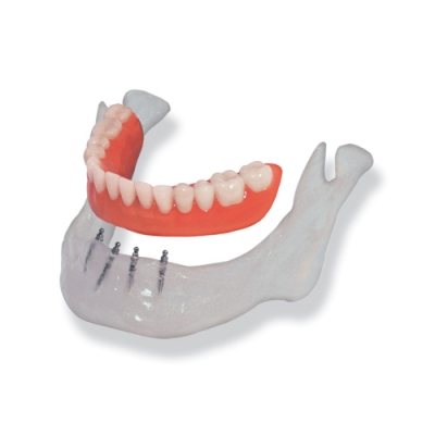 MINI Zwei Implantat Länge 11,5mm